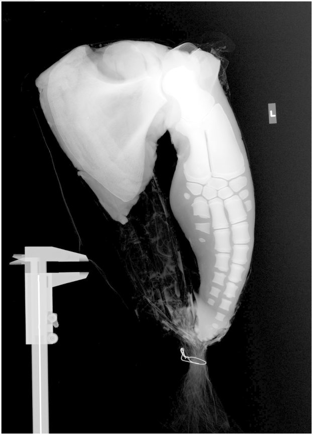 Ein Röntgenbild eines menschlichen Beins mit einem sichtbaren Bruch in der Mitte, wahrscheinlich eine Bänderverletzung, vor schwarzem Hintergrund.